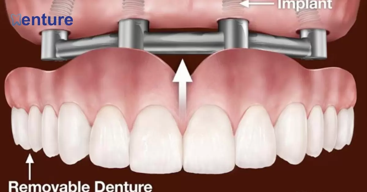 Can You Get Implants After Dentures?
