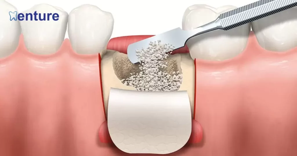 Dental Implants and Bone Density