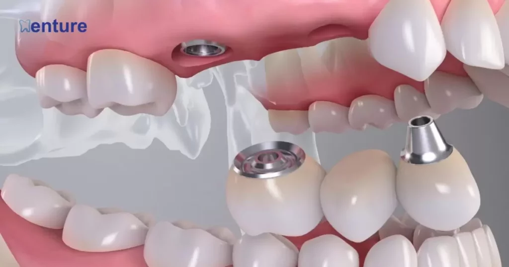 Dental Implants In Ocean Dental Cancun