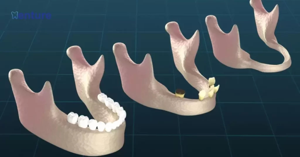 Do Dentures Cause Jaw Bone Loss?