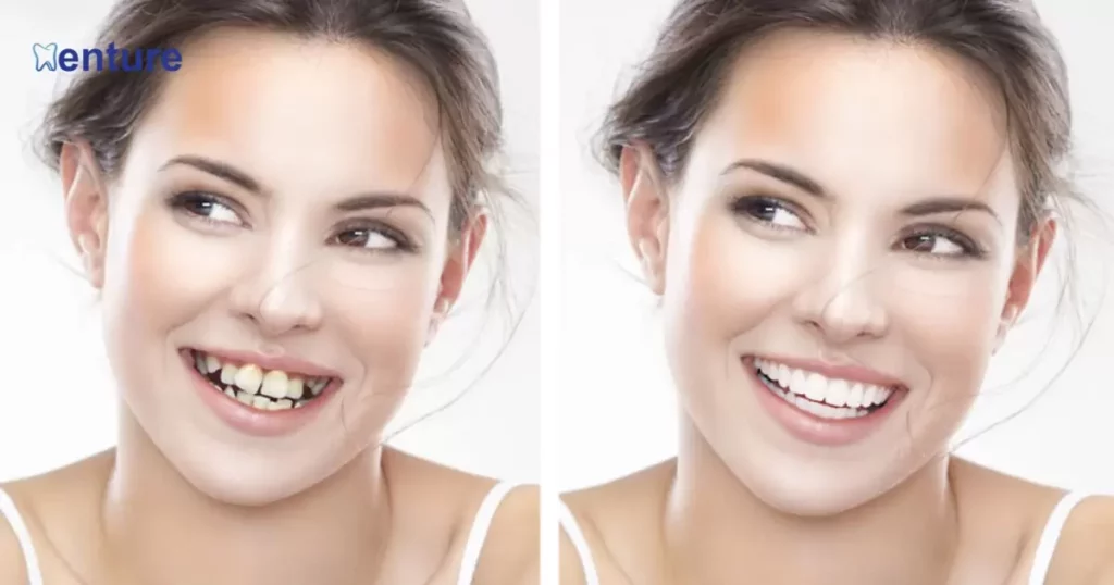 Do Dentures Change Your Face?
