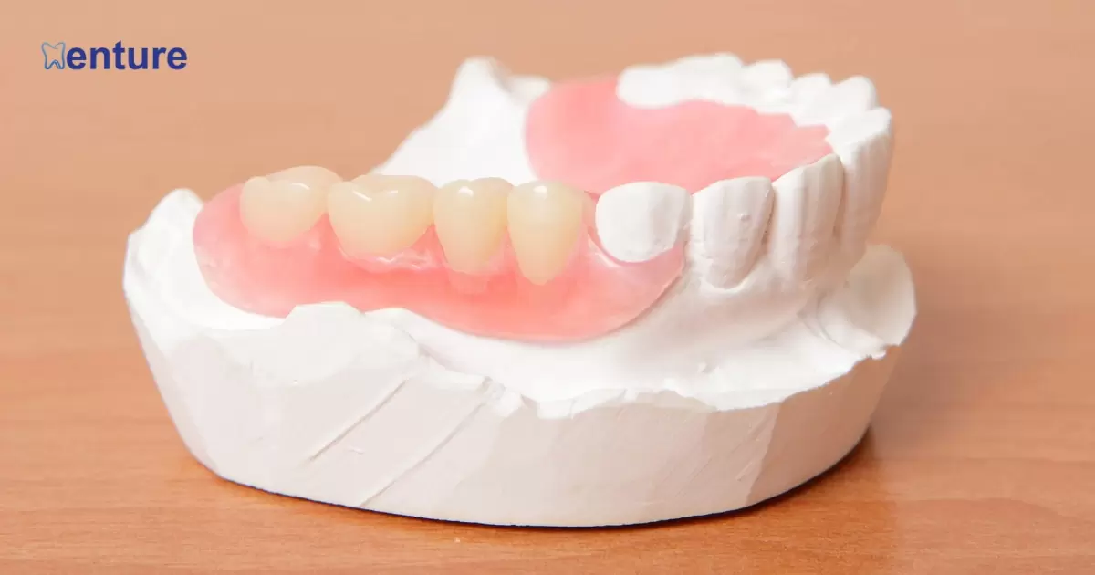 How Do Partial Dentures Stay In Place?