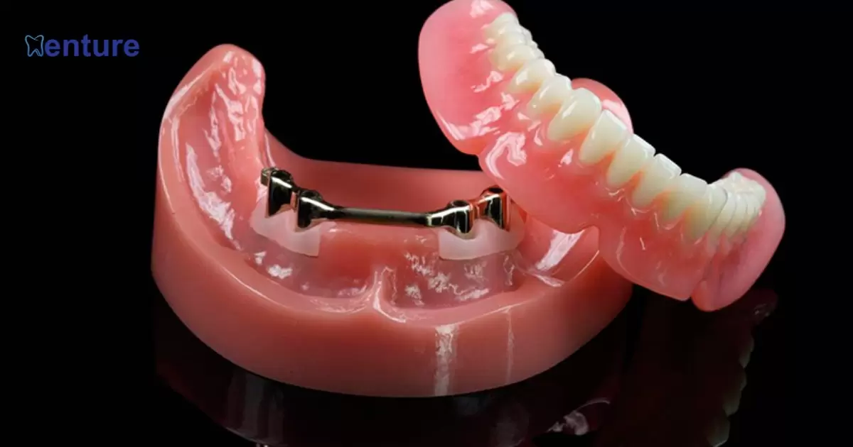 How To Remove Snap On Dentures?