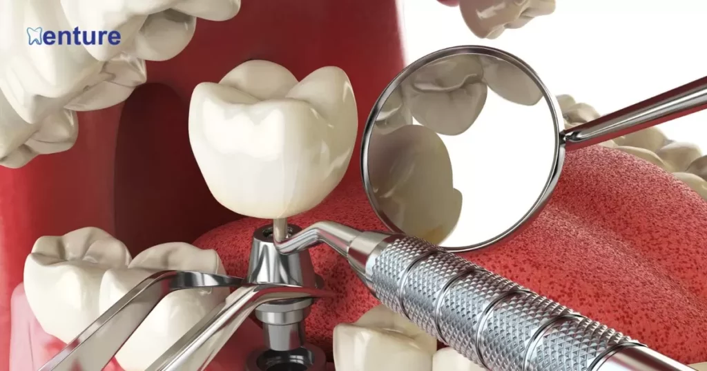 Replacing A Few Teeth With Dental Implants