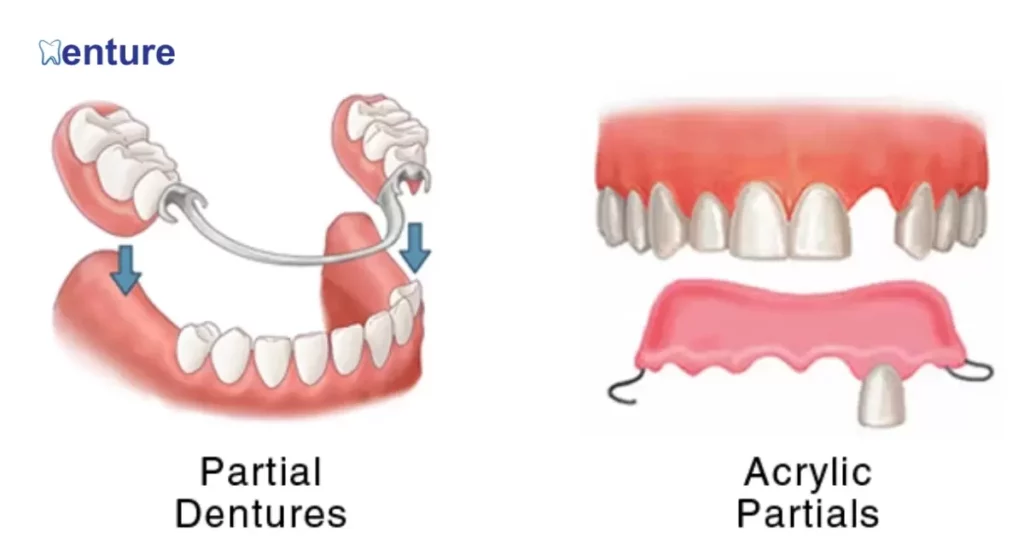 What Are Partial Dentures & How Do They Stay Put?