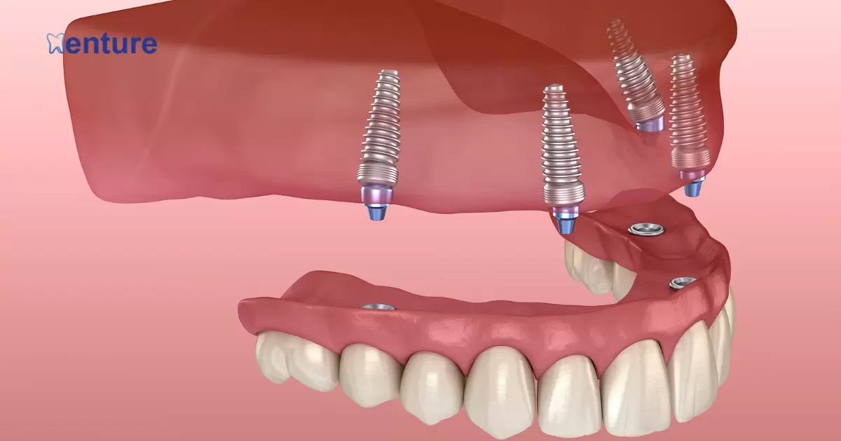 How To Remove Implant Supported Dentures?