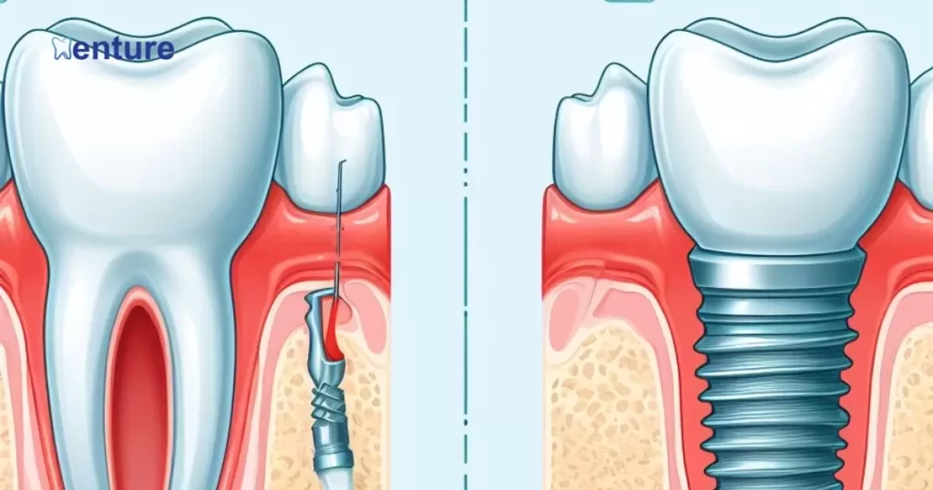 Single Tooth Denture Vs Implant