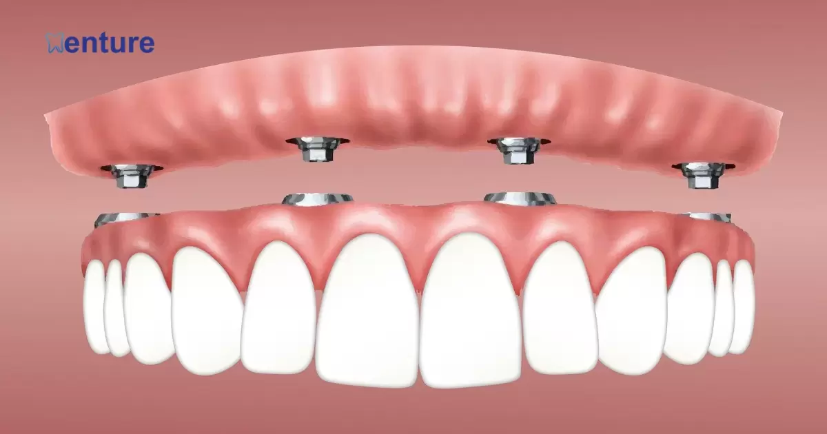 What Is A Fixed Denture?