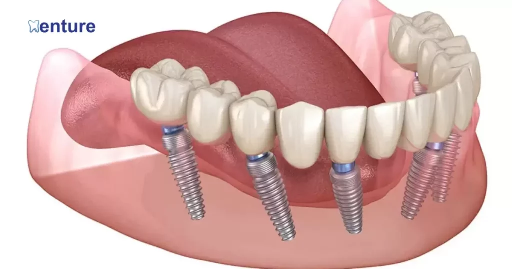 Types of Fixed Dentures
