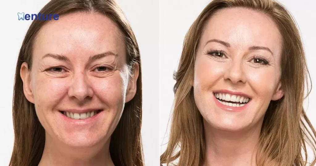 Will Facial Sagging Improve with New Dentures?