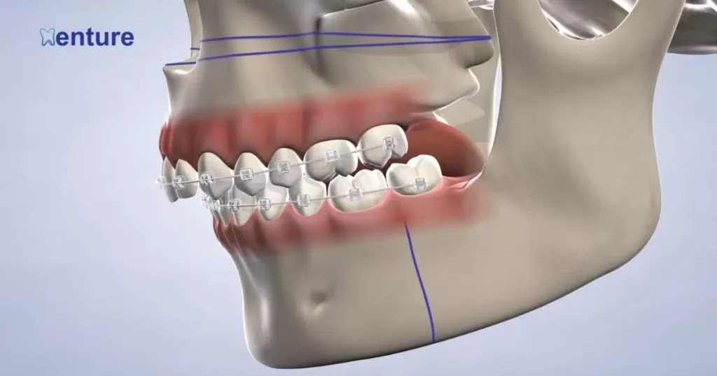 The Role Of Teeth In Facial Structure