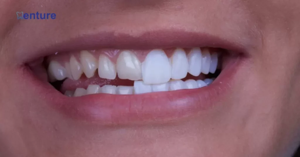 The Reasons Why Veneers Look Like Horse Teeth