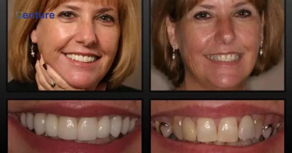Dentures vs Real Teeth