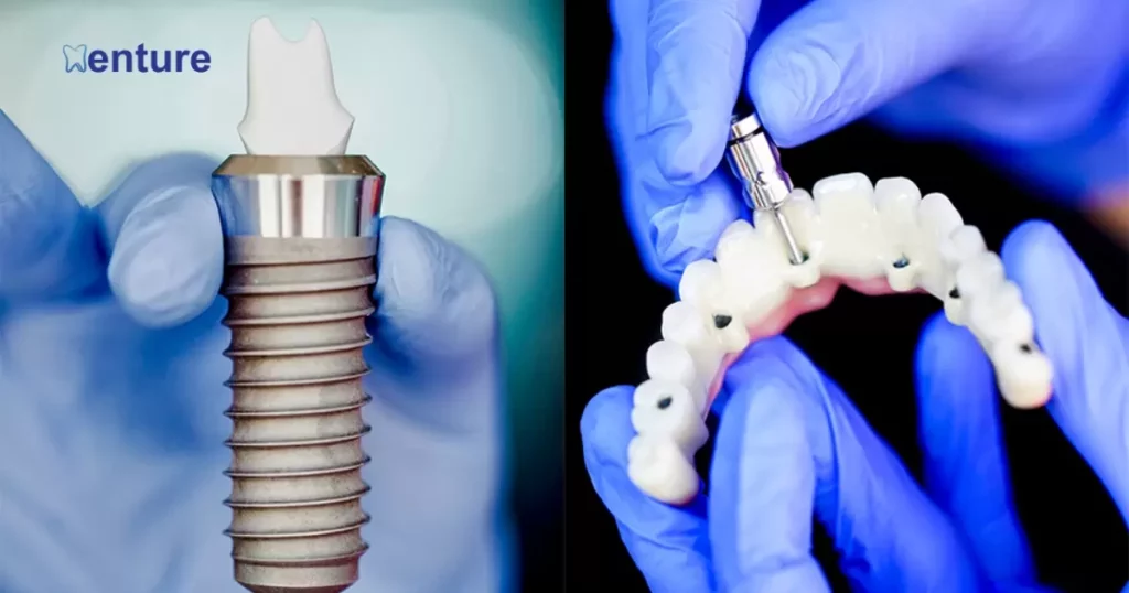 Anchored Dentures vs Dental Implants