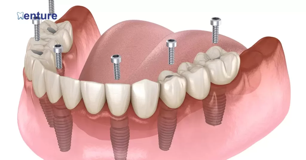 How Anchored Dentures Work?