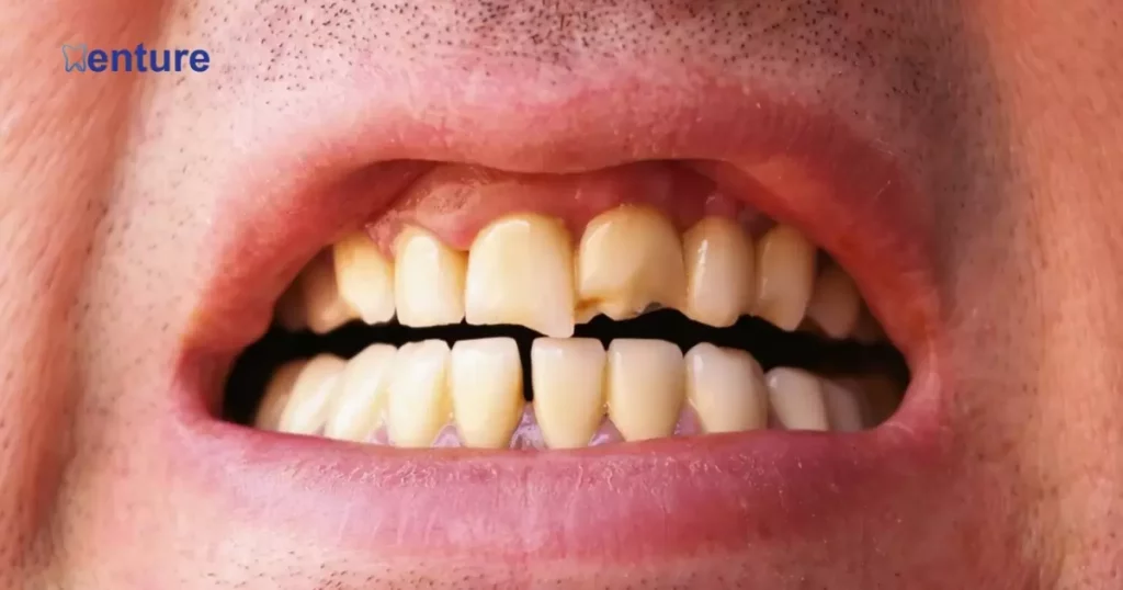 Broken or chipped dentures