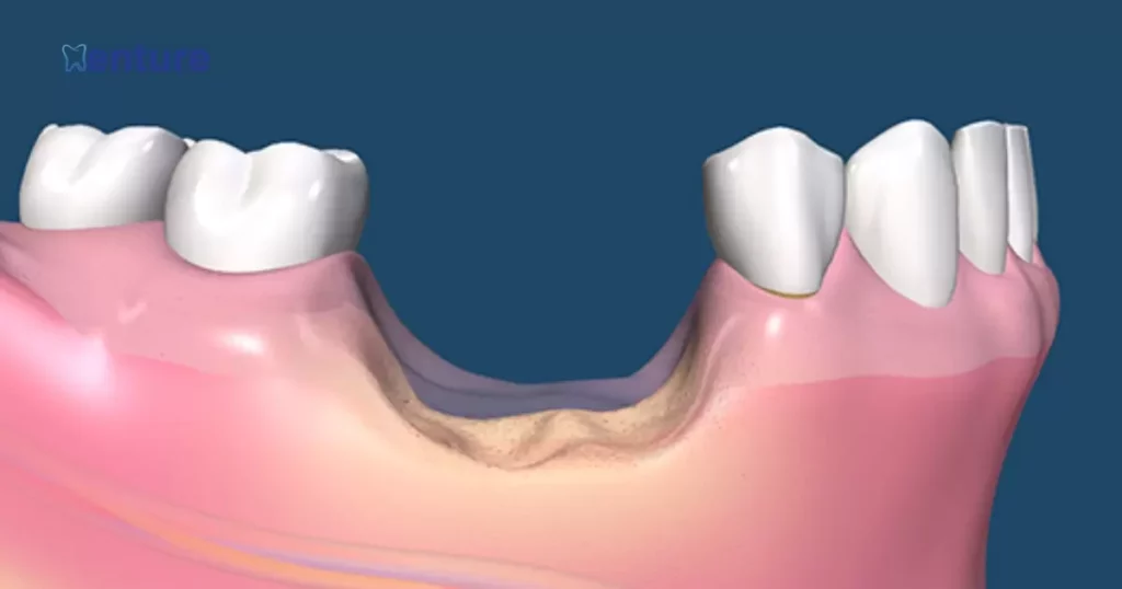 Alternative Solutions for Dentures with Bone Loss
