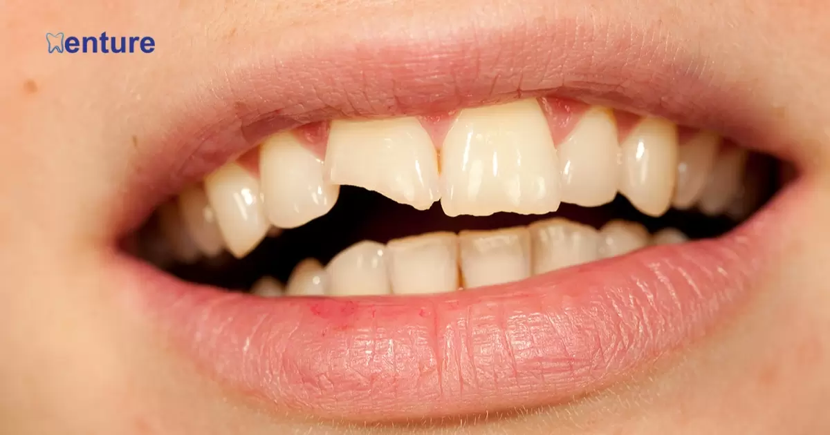 Can A Chipped Tooth On A Denture Be Repaired?