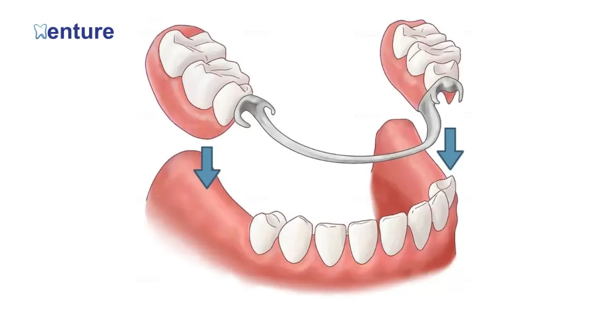 Can A Tooth Be Added To A Partial Denture?