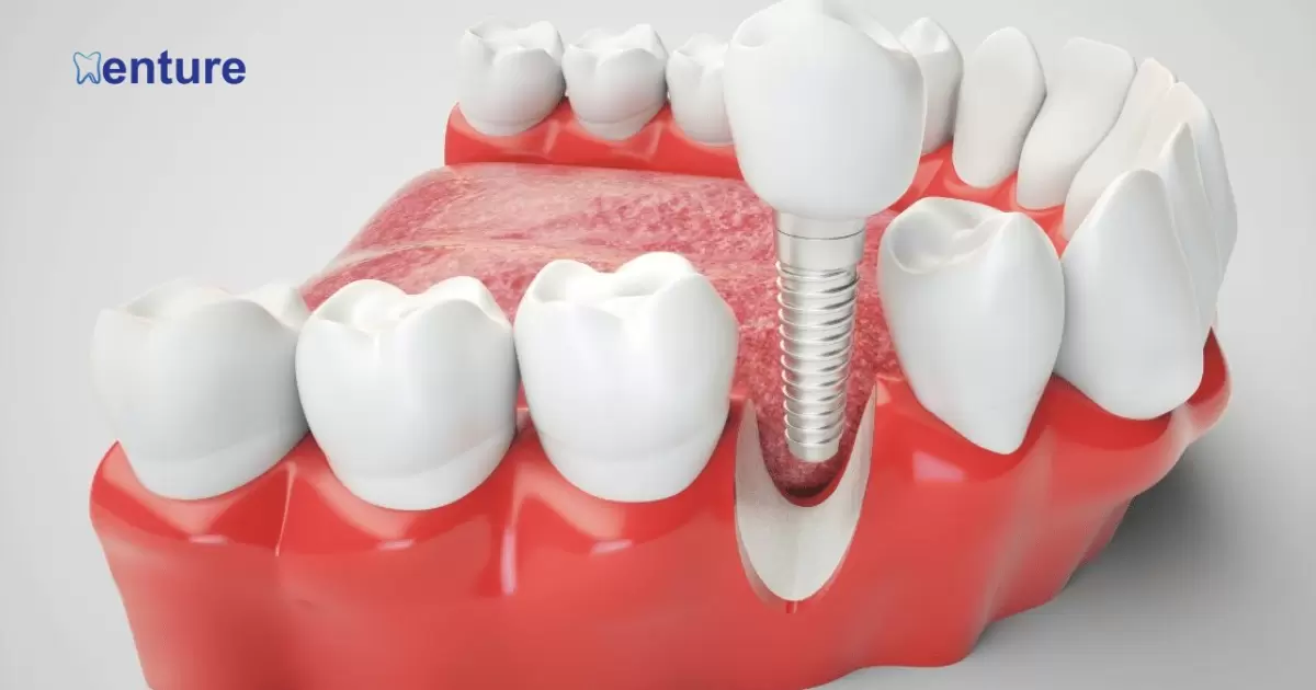 Can Dentures Be Converted To Implants?