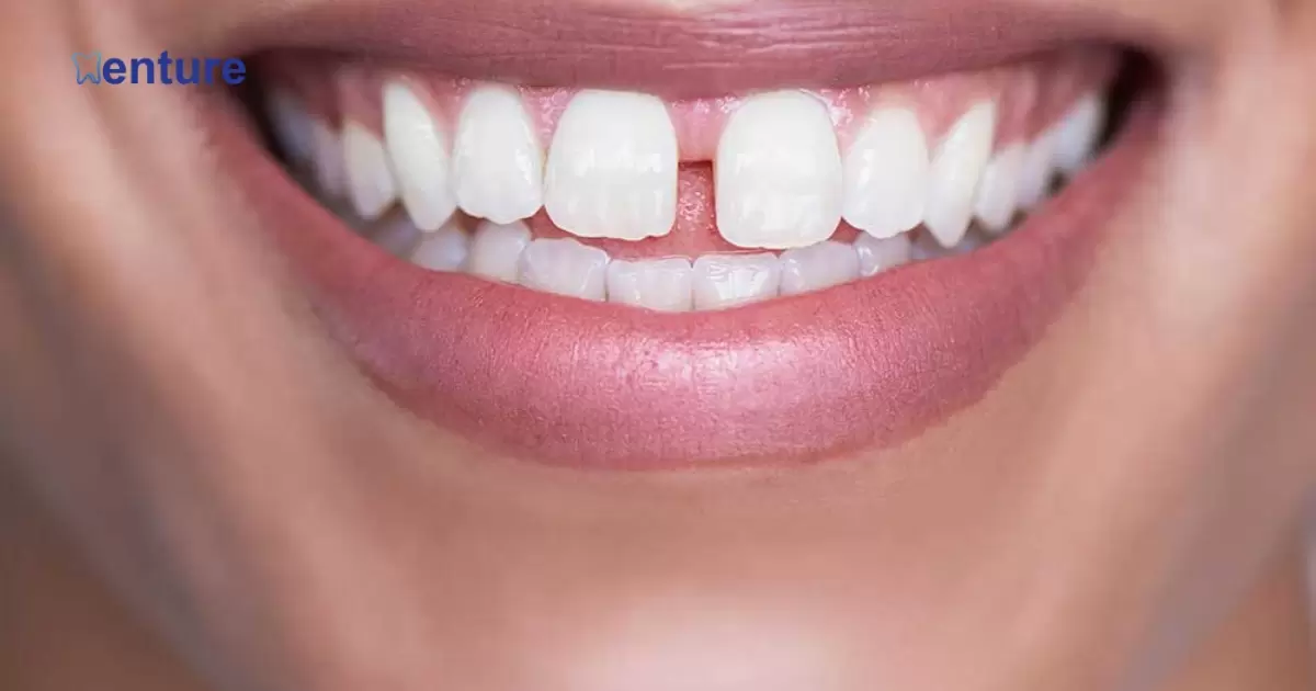 Can Dentures Be Made With A Gap?