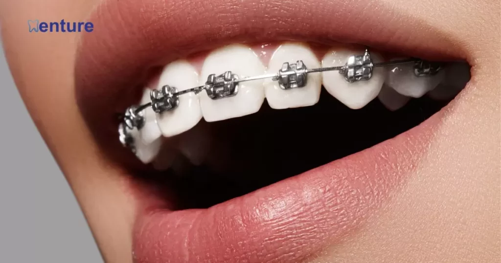 Can I get braces with dentures?