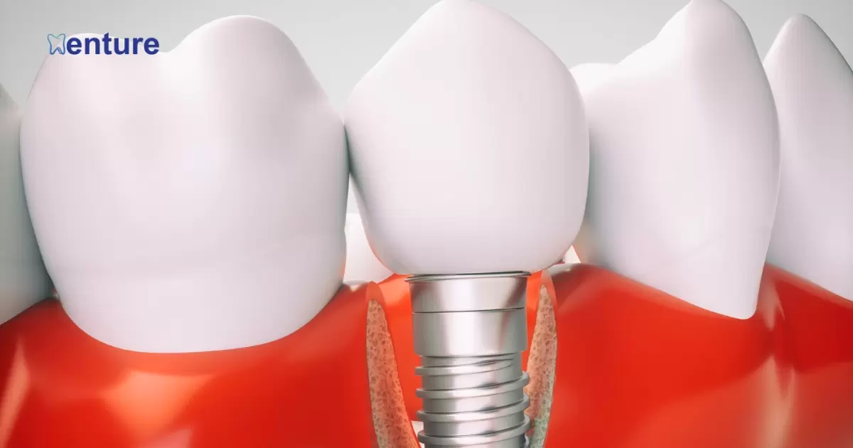 Can I Get Implants If I Have Dentures?