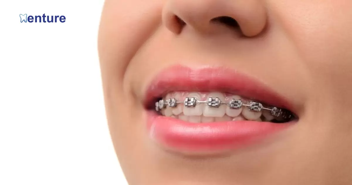Can You Get Braces With A Partial Denture?