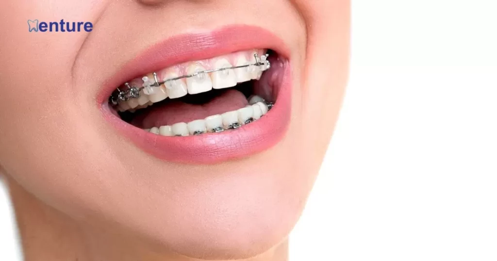 Compatibility of Braces and Partial Dentures
