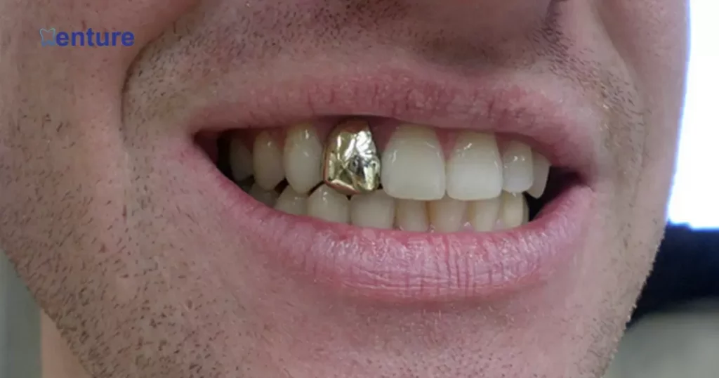 Considerations When Getting Gold Teeth on Dentures