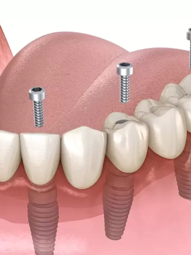 Can Existing Dentures Be Implanted?