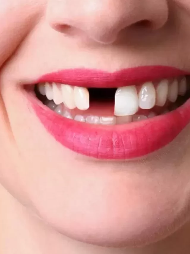 How Many Teeth Can You Lose Before You Need Dentures?