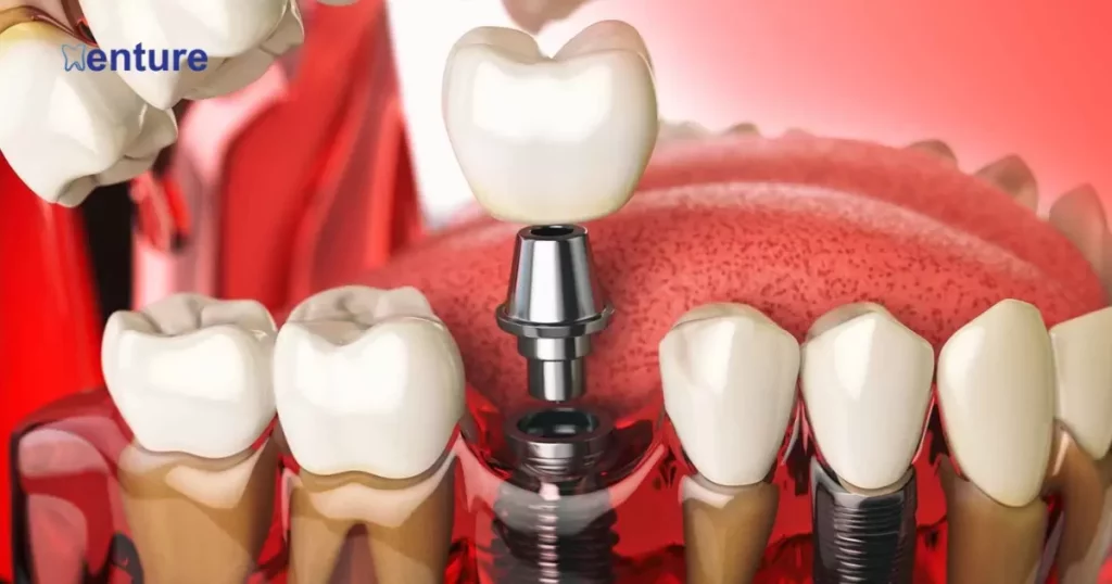 Dental Implants For Denture Wearers