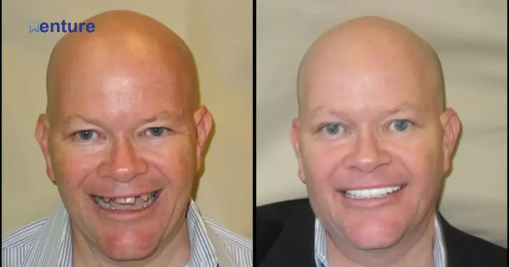 Dentures Before And After