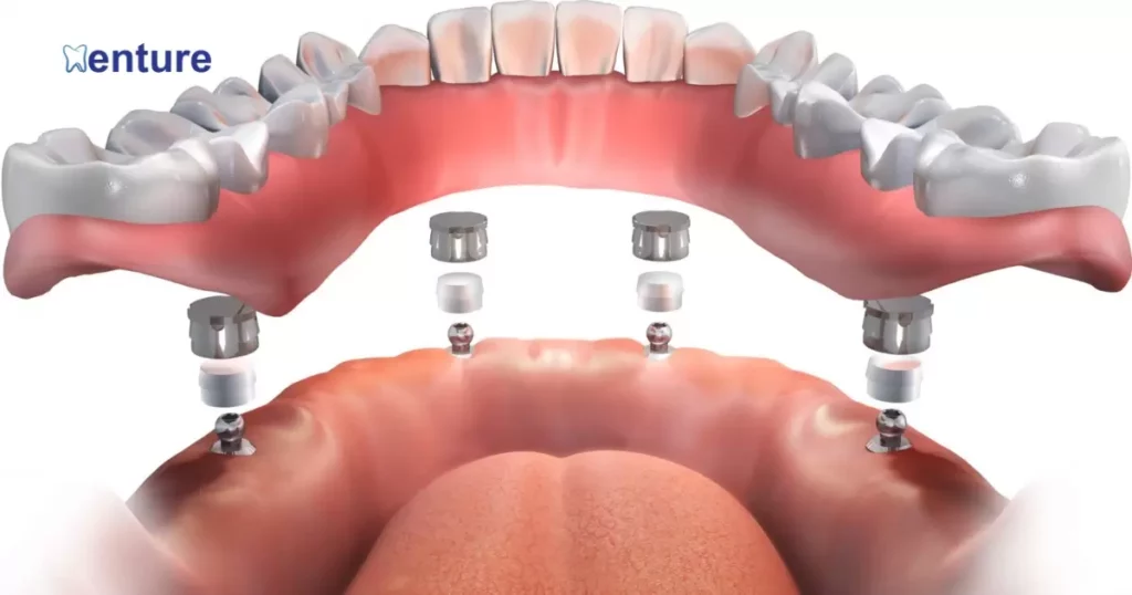Dentures To Implants