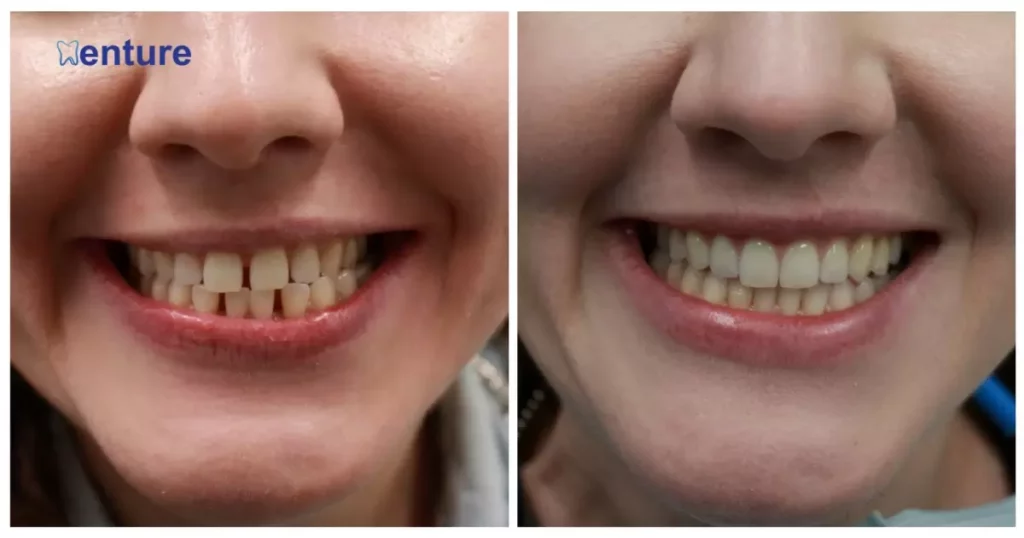 Distinguishing Factors Between Veneers and Dentures