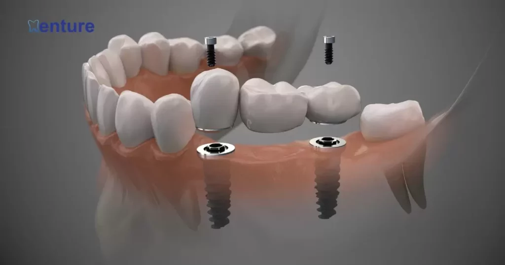 Do Modern Dentures Fit Better?