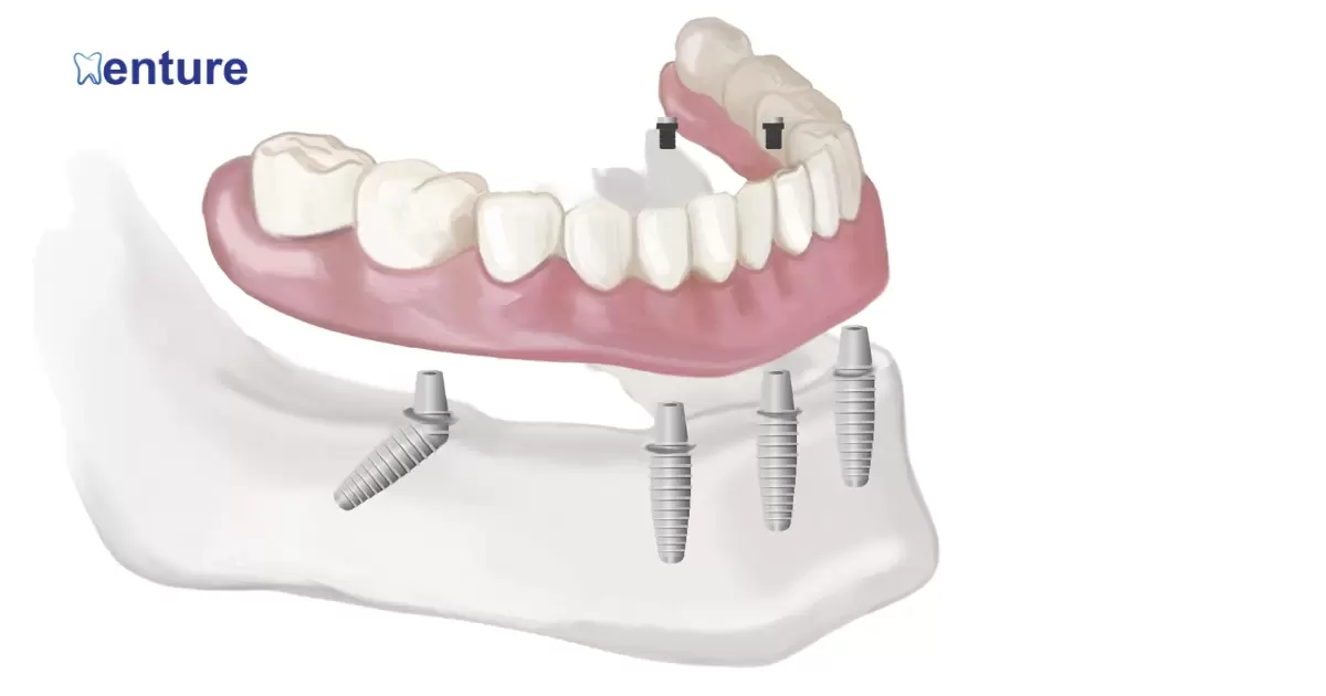 Do Snap In Dentures Prevent Bone Loss?