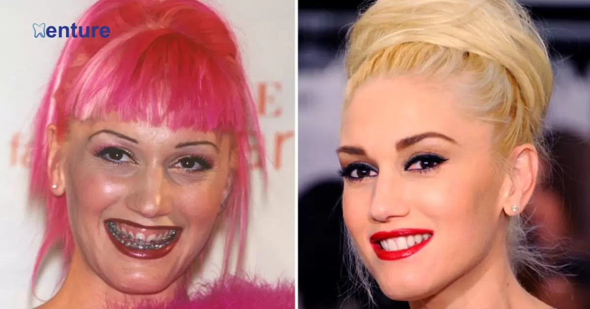 Does Gwen Stefani Have Dentures?