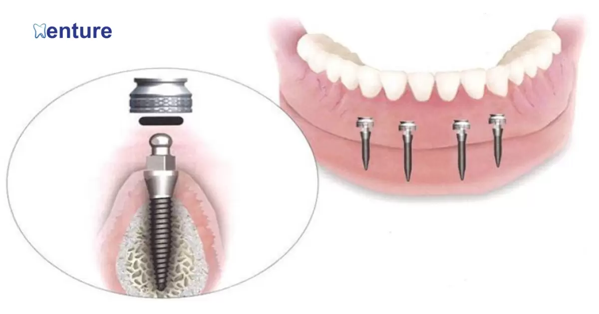 How Do Magnetic Dentures Work?