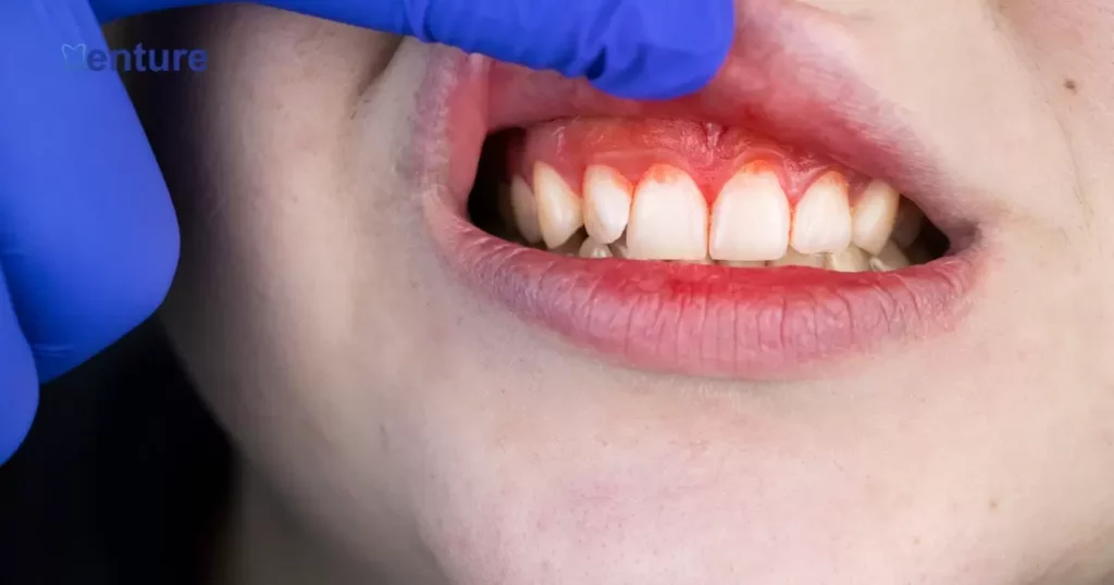 How Do They Replace Teeth After Gum Disease?