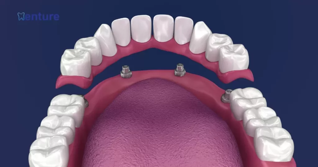Implant-Supported Partial Dentures