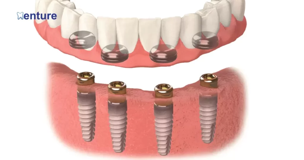 Magnetic Denture Implants