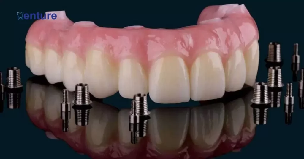 Permanent Implant Dentures