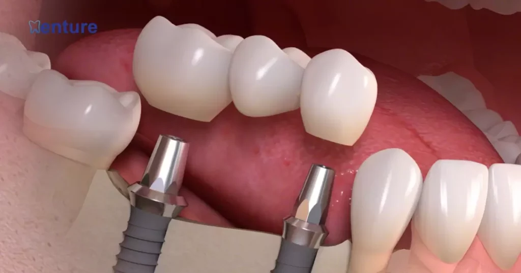 Replacing Several Teeth with Dental Implants
