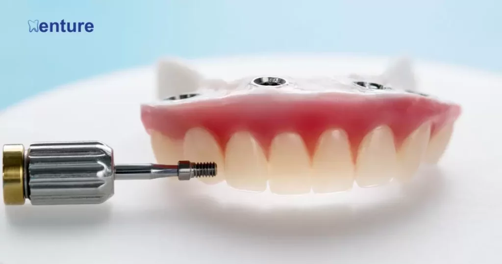 The Future of Screw-Retained Dentures 
