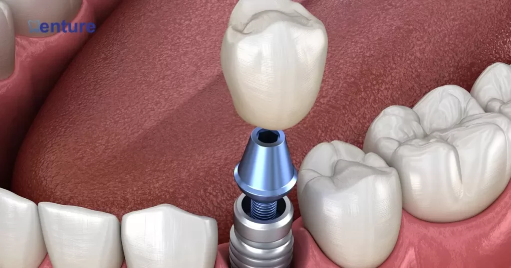 The Process of Implanting Existing Dentures