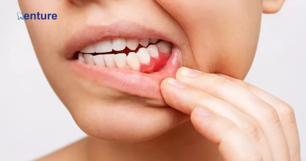 The Relationship Between Gum Disease and Permanent Dentures