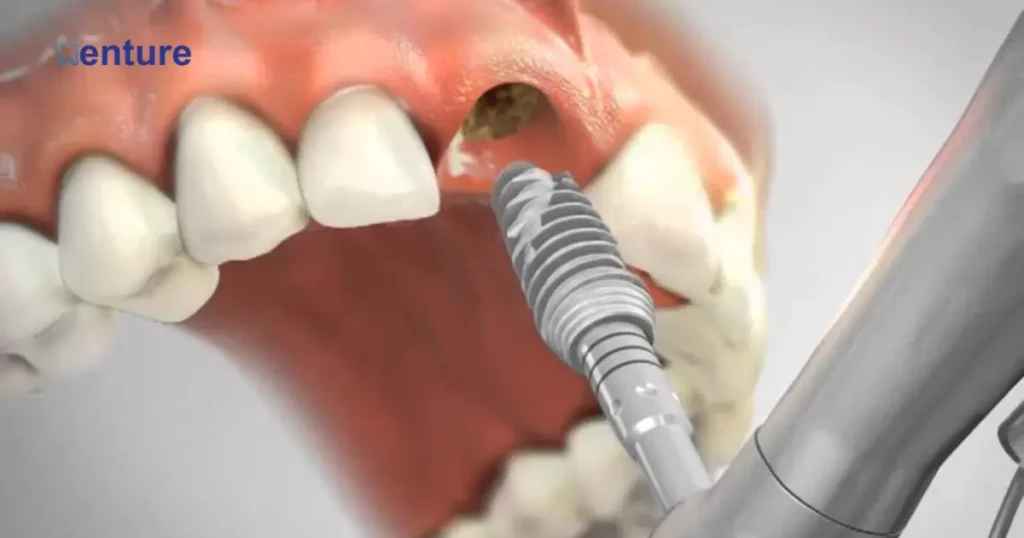 The Viability of Dental Implants