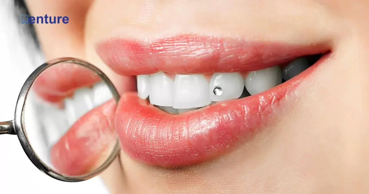 Tooth Gems On Dentures